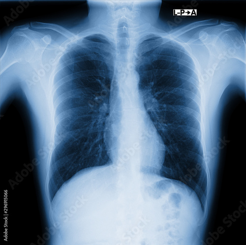 xray of chest
