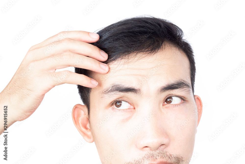 Obraz premium Young man serious hair loss problem for health care medical and shampoo product concept, selective focus