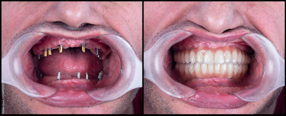 full mought re construction by dental implants and ceramic crowns - obrazy, fototapety, plakaty 