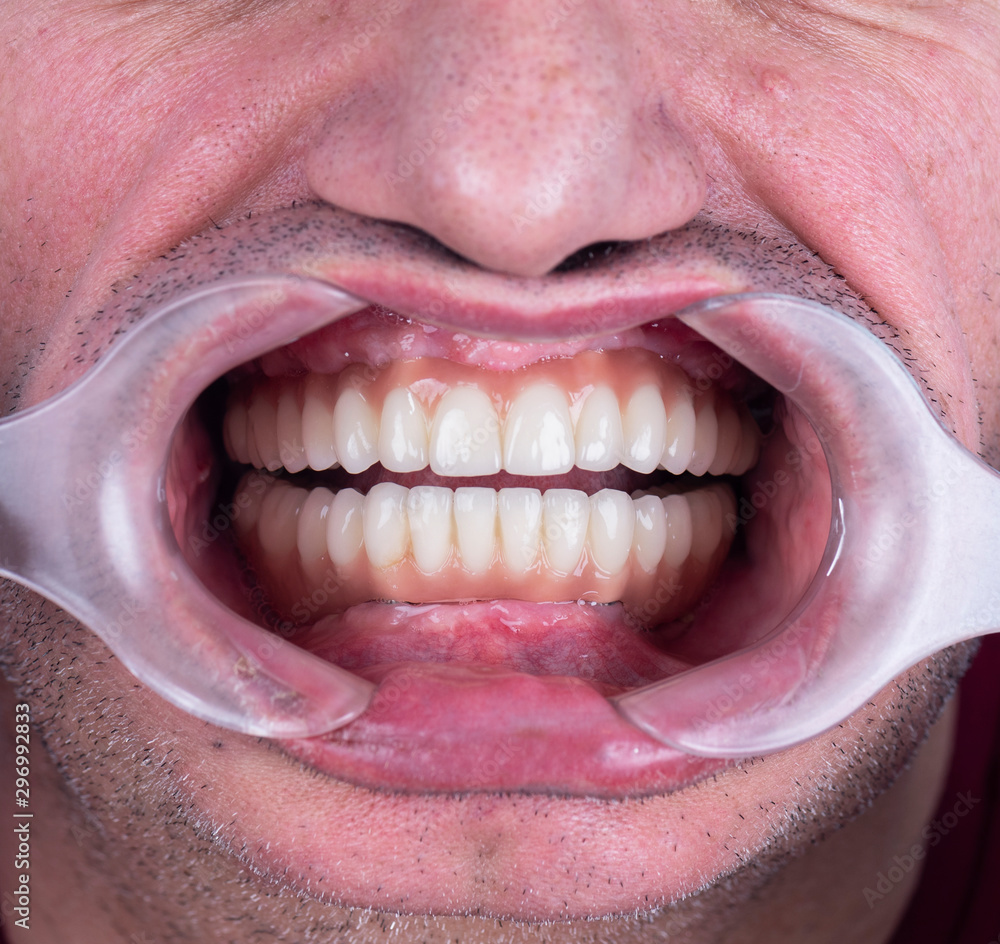 Obraz premium full mought re construction by dental implants and ceramic crowns