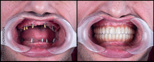 full mought re construction by dental implants and ceramic crowns
