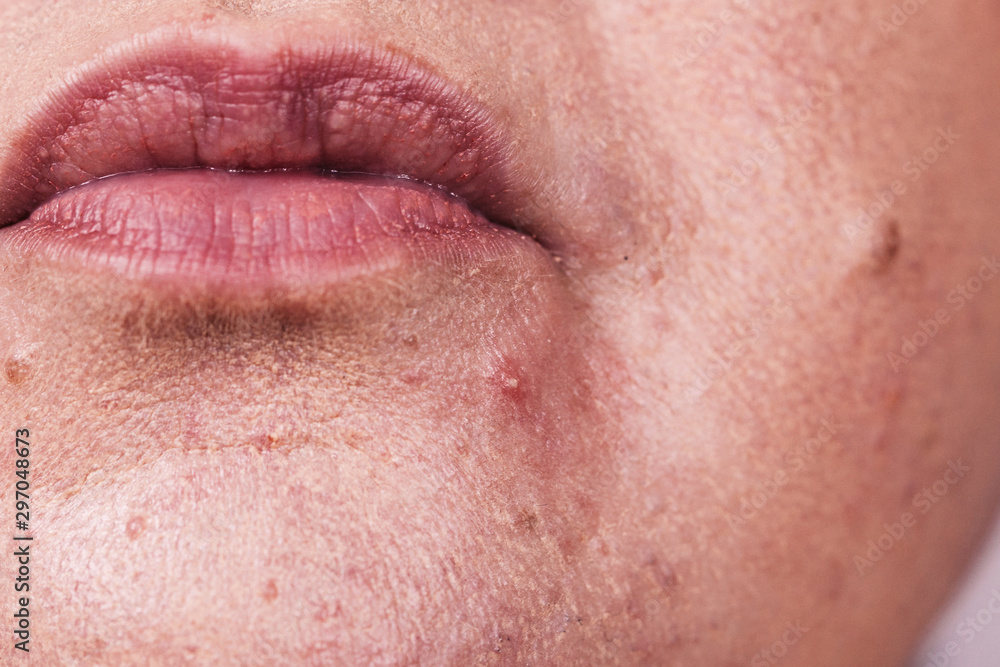 Female face with acne skin problem Female face with acne skin problem