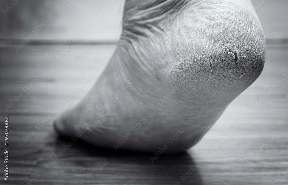 Obraz premium Closed-up of cracked heels, also known as fissures, a common foot problem. black and white tone