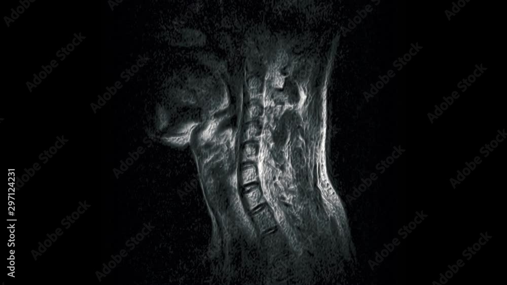Volumetric MRI of the cervical spine, detection of protrusions and hernias Volumetric MRI of the cervical spine, detection of protrusions and hernias
