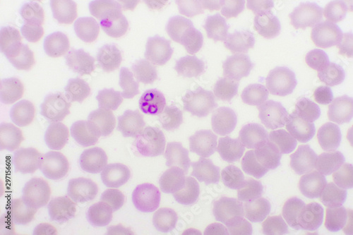 Malaria parasite in red blood cells, ring form stage of Plasmodium falciparum, original magnification 1000x photo