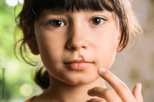 Herpes on upper lip of little girl.  Child with cold sores on her lips.