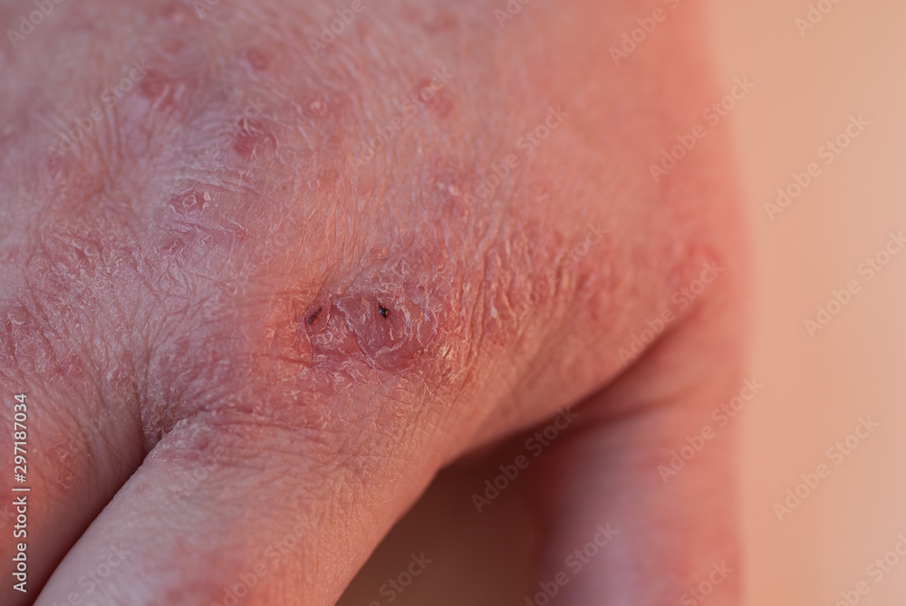 Psoriasis auf der Handoberfläche Psoriasis auf der Handoberfläche