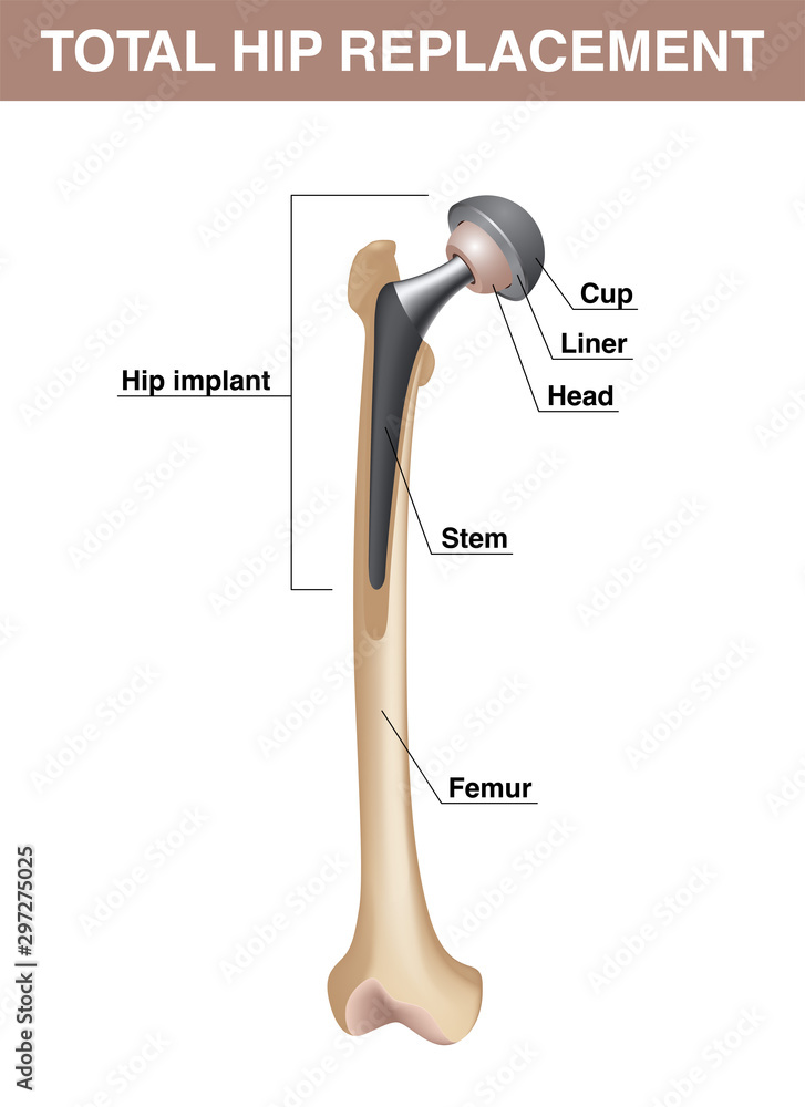 Total hip replacement. Femur with hip implant. Vector realistic medical ...