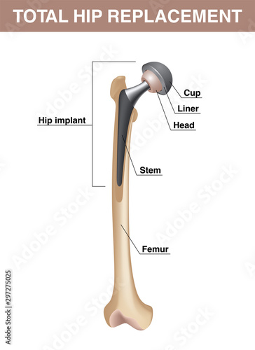 Total hip replacement. Femur with hip implant. Vector realistic medical illustration with explanations isolated on white background