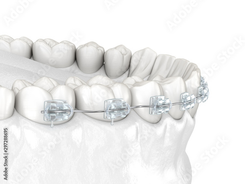 Teeth and Clear braces. Medically accurate dental 3D illustration