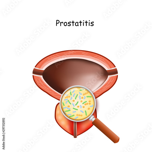 prostatitis. Male bladder and prostate