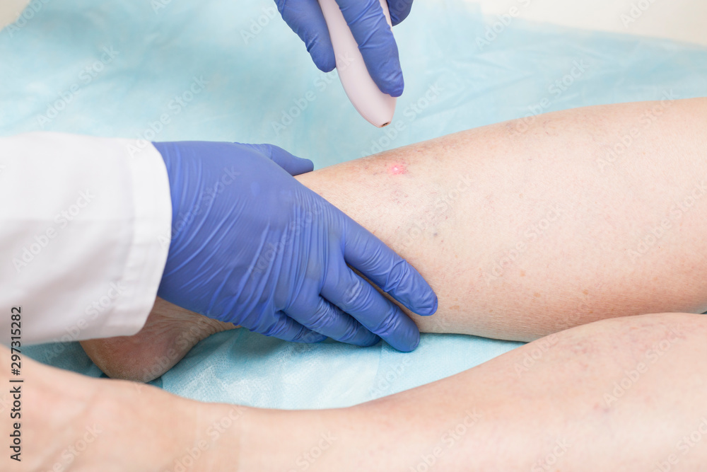 Specialist doctor conducts endovenous laser coagulation of the veins of the lower extremities. The concept of treatment for varicose veins and thrombosis