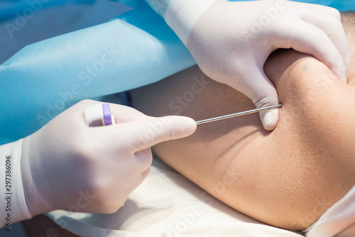 Εκτύπωση καμβά An oncologist, using a long needle, pierces a childs ilium to diagnose bone marr