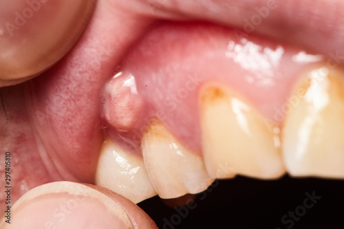 inflammation of the gums abscess closeup photo