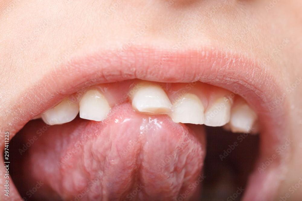 Obraz premium Baby tooth, close-up of the tooth that falls macro shot