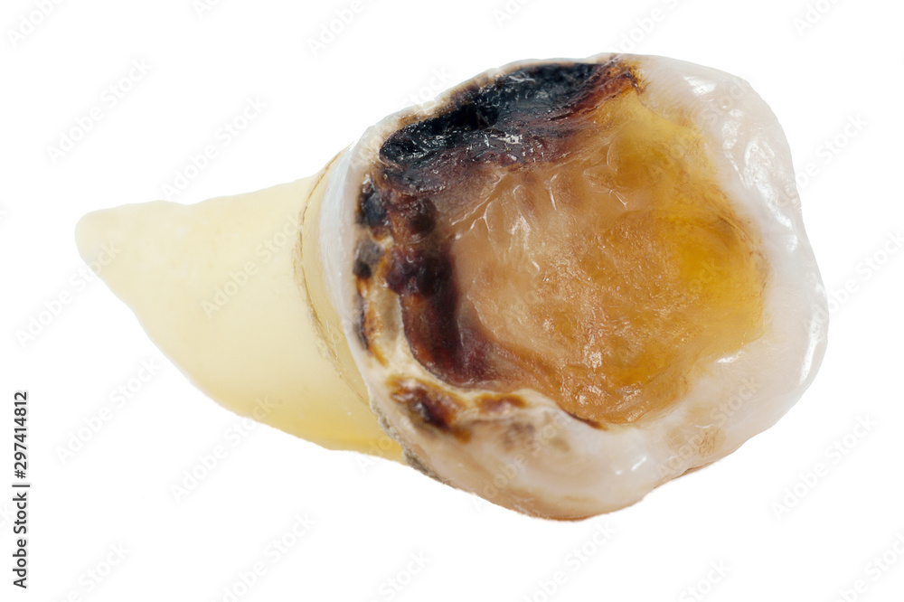 extracted caries tooth isolated on white background close-up macro, lower molar
