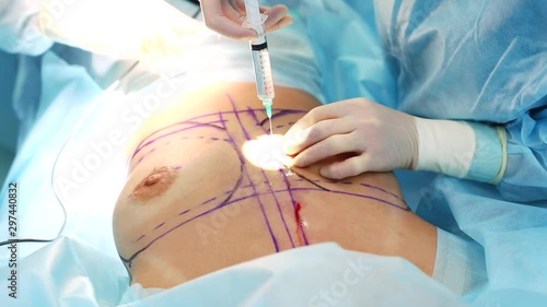 Operating room: preparations for liposuction surgery. a team of surgeons do the operation of liposuction to a girl. photo