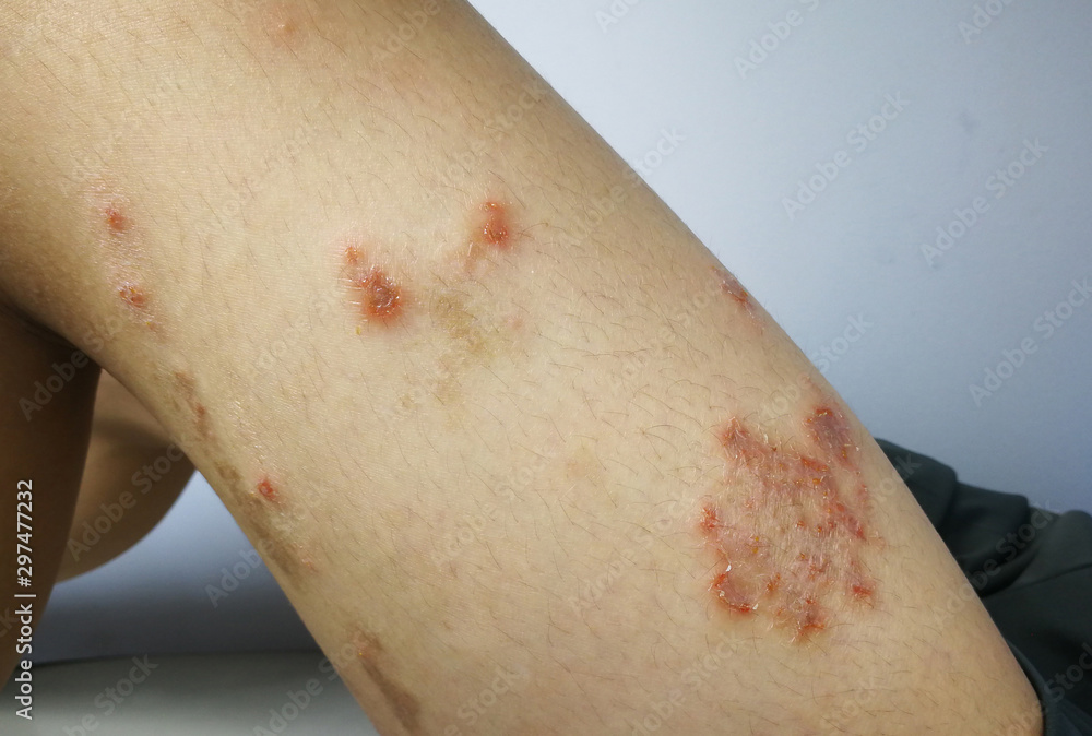 Young boy has Chronic rash on skin. Grass allergic skin disease. Atopic