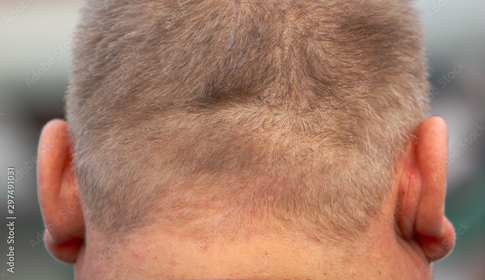Naklejka premium Nape and ears of a fat man