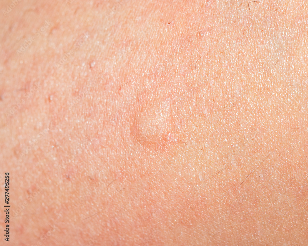 trace from a mosquito bite on the skin Stock Photo