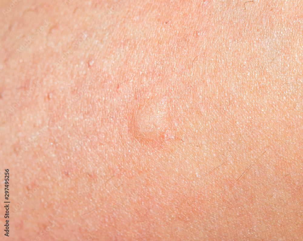 Mosquito Bites on the Skin Under the Breast Stock Photo - Image of