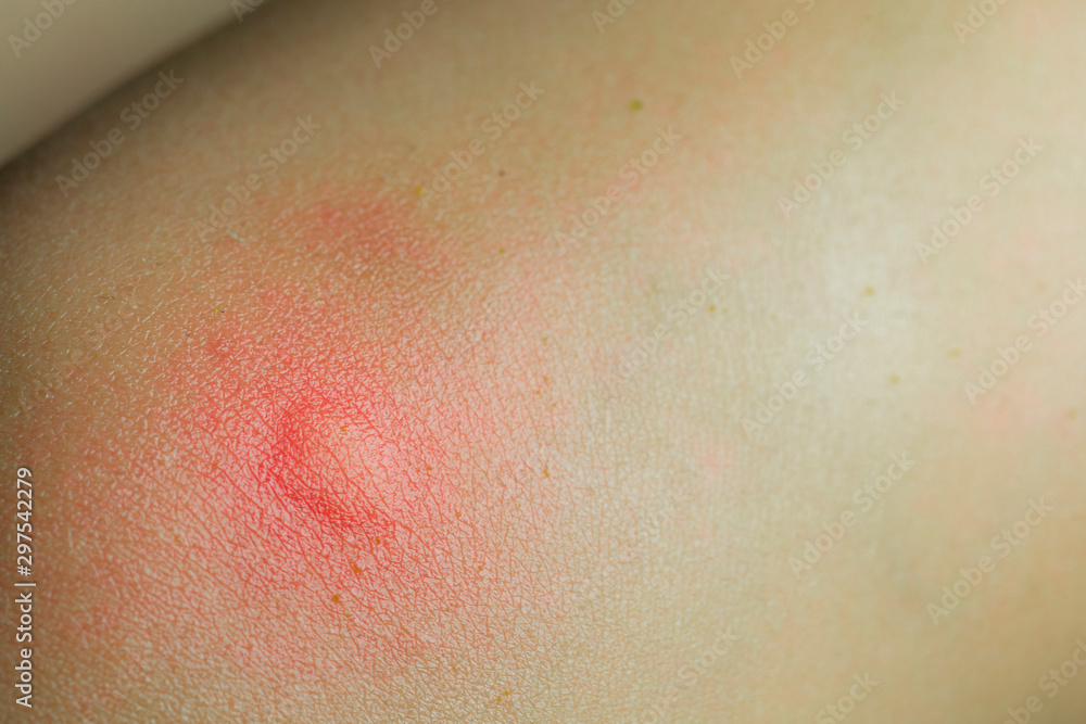 Fototapeta premium Red skin rash caused by an insect bite showing inflammation and irritation.