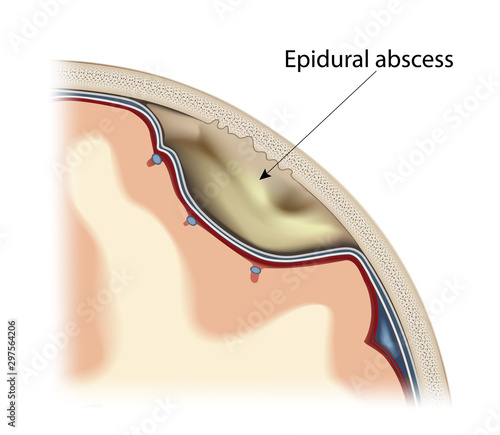 Epidural abscess of the human brain. Visual image of the location of the focus of infectious inflammation. Isolated on a white background. Vector graphics.