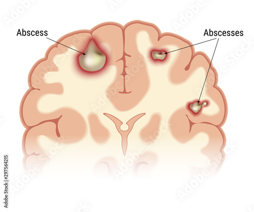 Intracerebral abscess of the human brain in the context. Visual image of the location of foci of infectious inflammation. Isolated on a white background. Vector graphics.