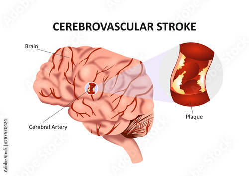 Cerebrovascualar Stroke/Accident