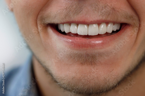 dental laminate veneers with smile design