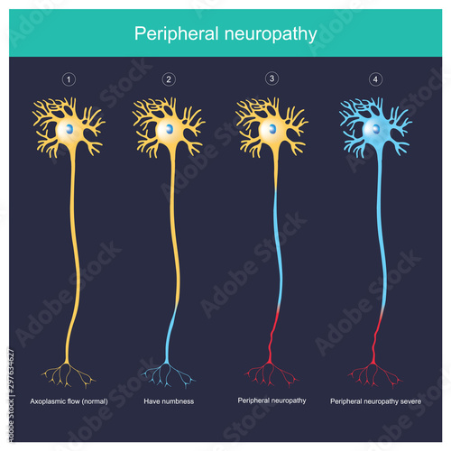 Peripheral neuropathy.  Explain illustration for The Peripheral neuropathy have numbness until severe inflammation.