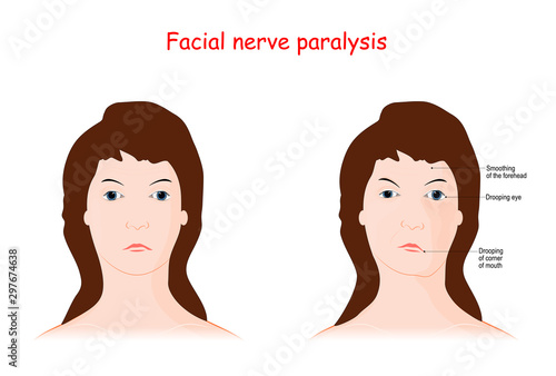 Facial nerve paralysis. Bell's palsy.