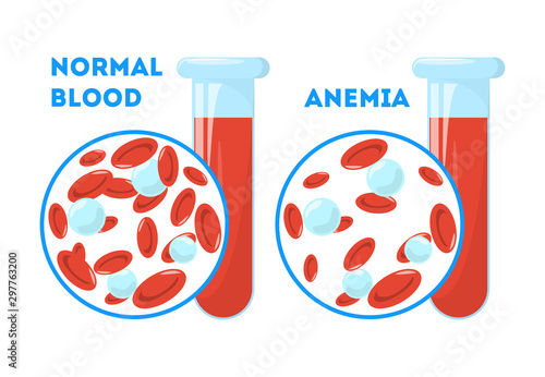 The Anemia symptoms. Normal and anemia blood