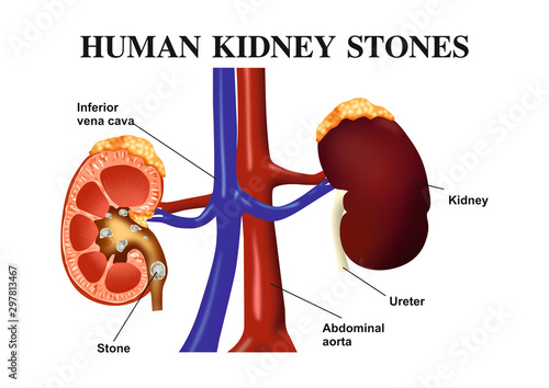 Human Kidney Stones