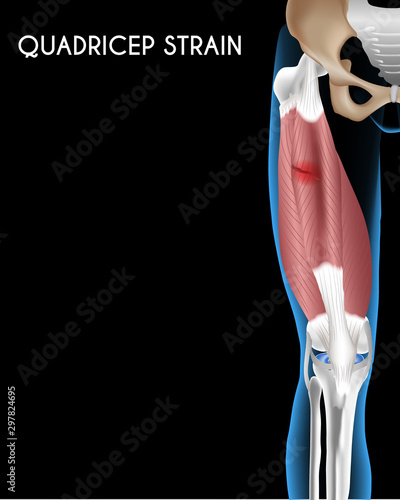  Medical orthopedic abstract. Treatment for orthopedics traumatology of knee bones and quadriceps muscle joints injury. Medical presentation, hospital. Vector Illustration