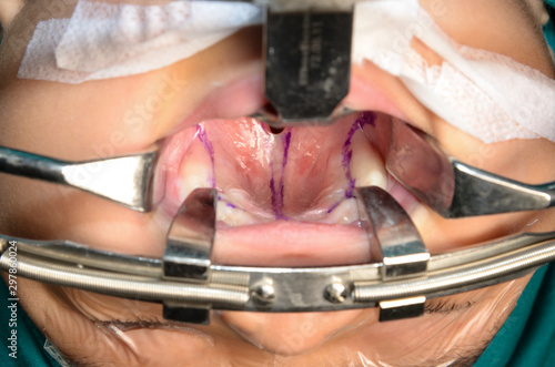 Young patient with cleft lip and cleft palate are treated by surgeons in operating room at the hospital. Children with cleft lip and cleft palate are treated by surgeons.