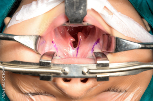 Young patient with cleft lip and cleft palate are treated by surgeons in operating room at the hospital. Children with cleft lip and cleft palate are treated by surgeons.