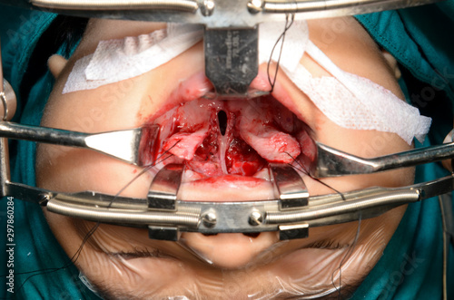 Young patient with cleft lip and cleft palate are treated by surgeons in operating room at the hospital. Children with cleft lip and cleft palate are treated by surgeons.