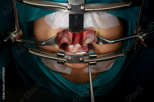 Young patient with cleft lip and cleft palate are treated by surgeons in operating room at the hospital. Children with cleft lip and cleft palate are treated by surgeons. photo