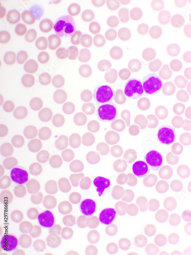 Fototapeta Naklejka Na Ścianę i Meble -  Blood picture of chronic lymphocytic leukemia or CLL, analyze by microscope, original magnification 1000x