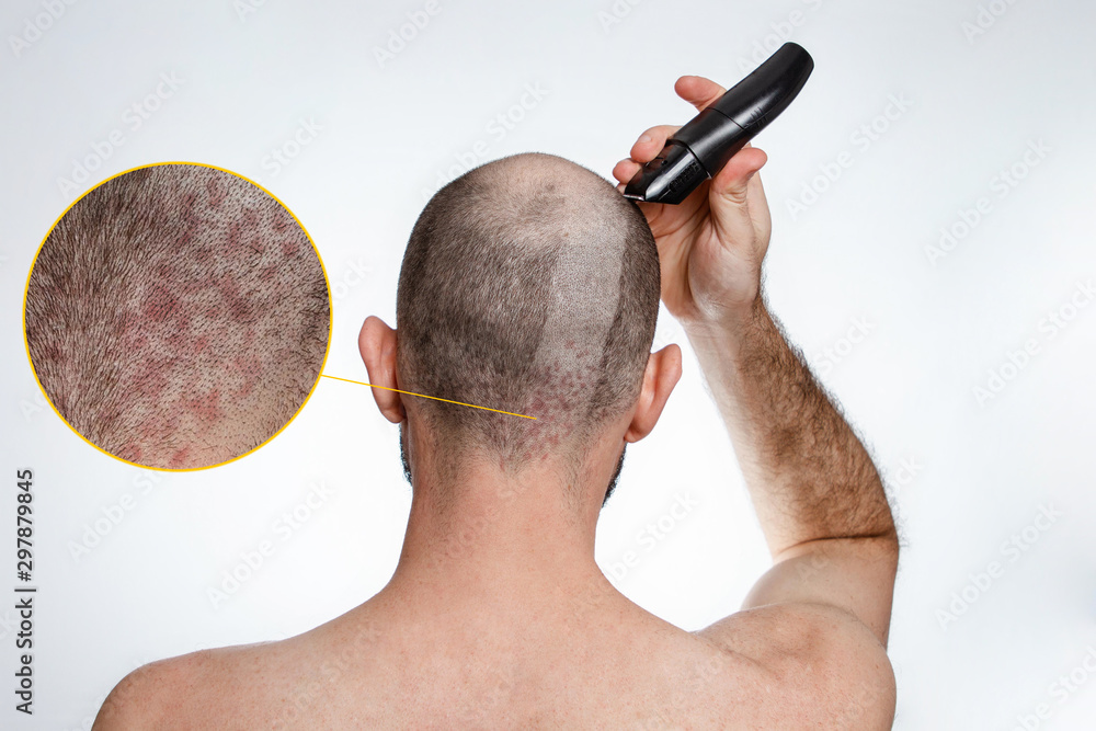 The concept of baldness and baldness. A man holds a hair clipper and