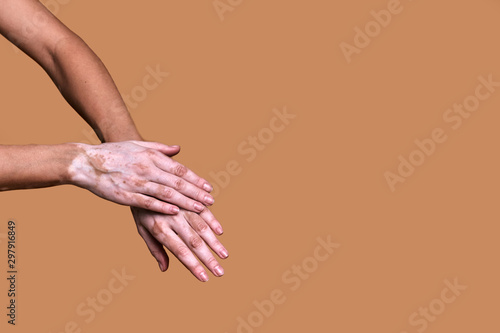 Women's hands with the disease vitiligo close-up on a beige background photo