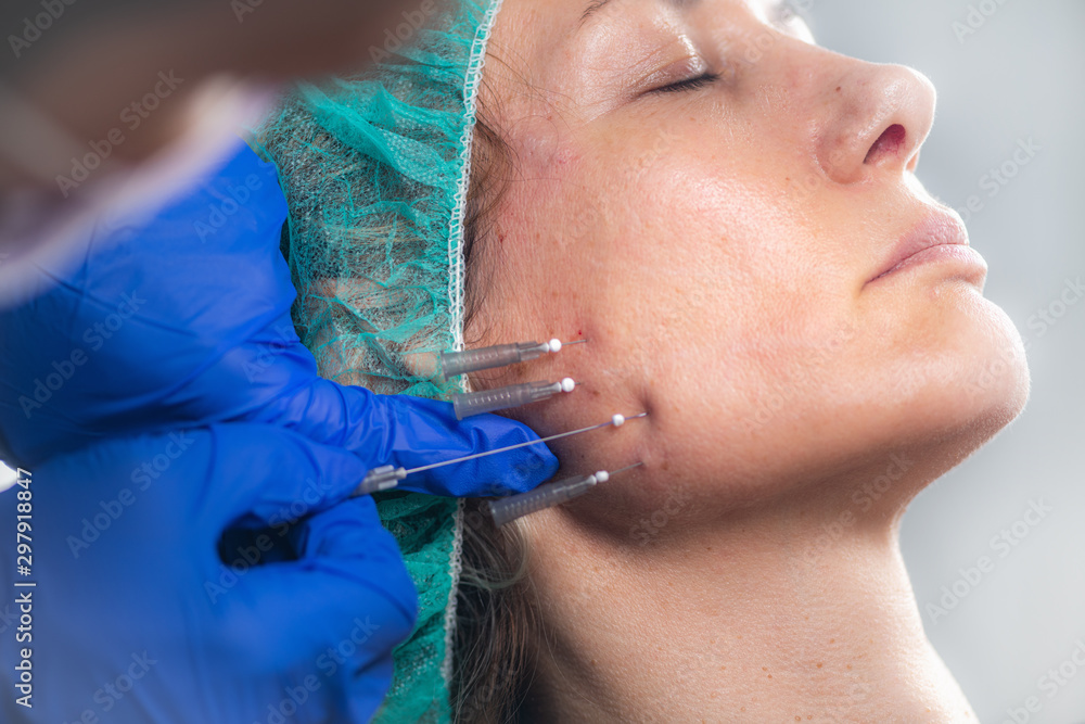 Mesotherapy Facelifting Procedure. 3D Meso Threads. Stock Photo Adobe