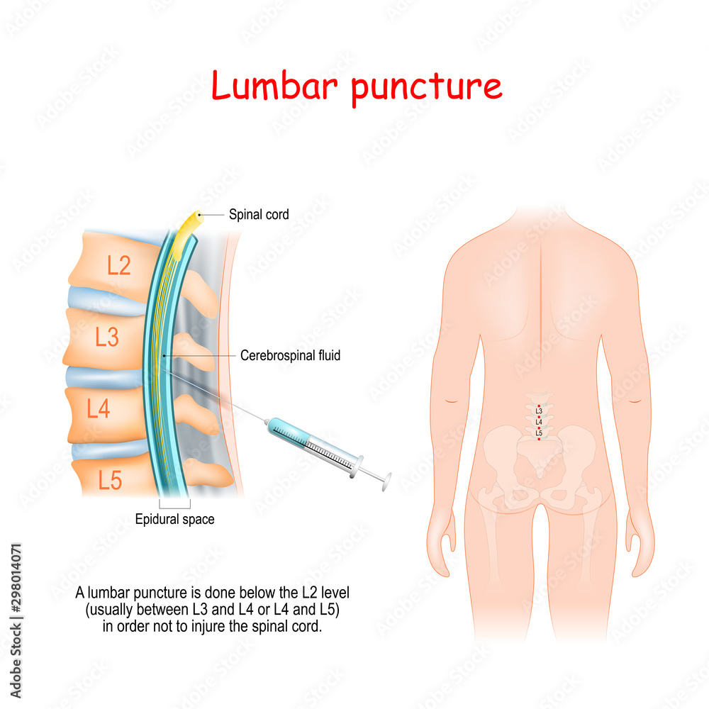 Vetor de Lumbar Puncture. Spinal Tap Procedure. Syringe needle inserted