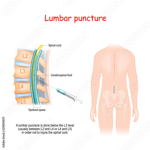 Lumbar Puncture. Spinal Tap Procedure. Syringe needle inserted into Epidural space