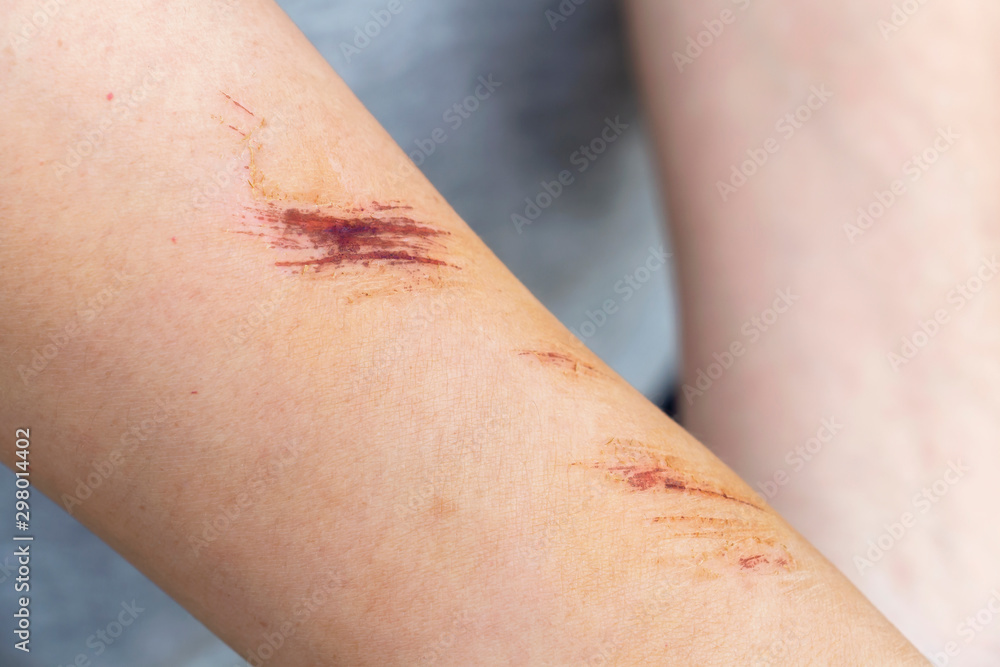 Fototapeta premium The wound form scabs on hand and arm. The wound happen during woman Injuries from falling down on road.