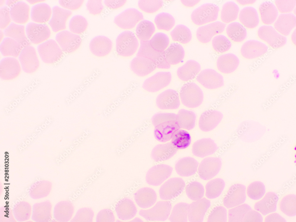 Malaria parasite in red blood cells, ring form stage of Plasmodium falciparum, original magnification 1000x