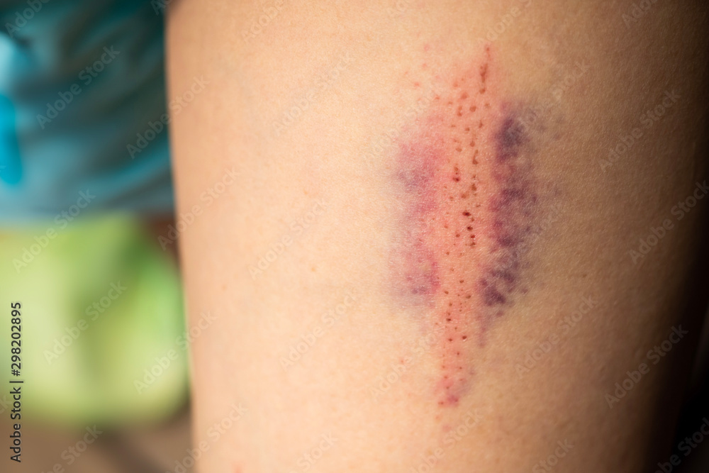 A close-up shot of bruises. A close-up shot of bruises.