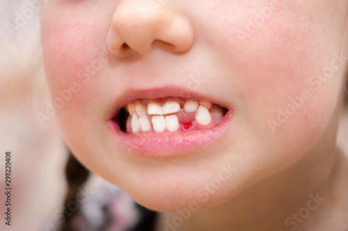 A wound in a child's mouth without one tooth is close-up. The girl just pulled out her baby teeth. Children's smile after visiting the dentist.
