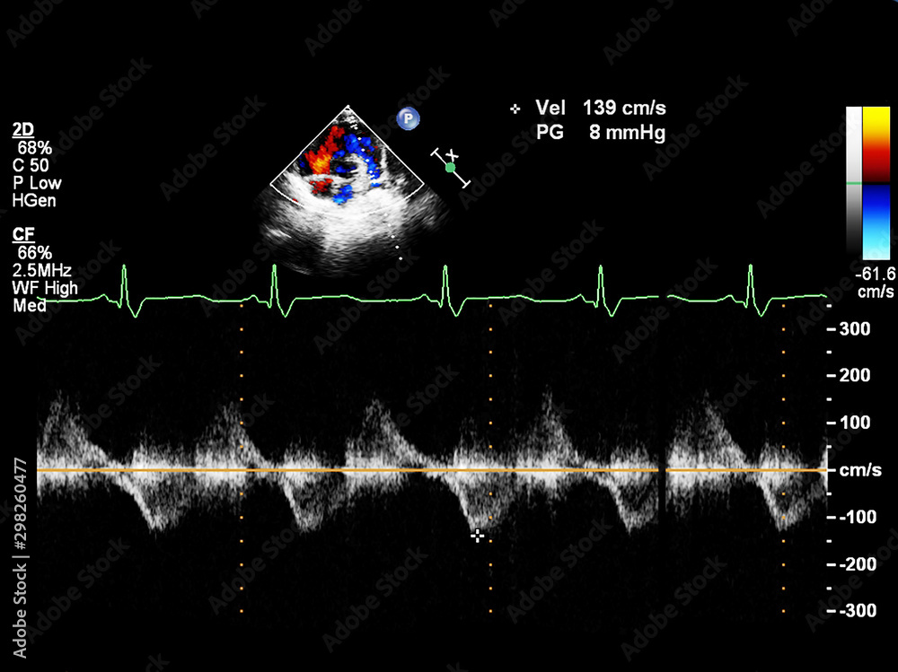 Screen of echocardiography (ultrasound) machine. Stock Photo | Adobe Stock